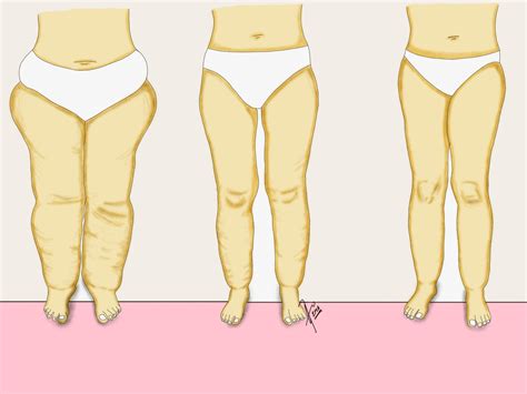 ¿Qué es el Lipedema? – asgcirujanosvasculares