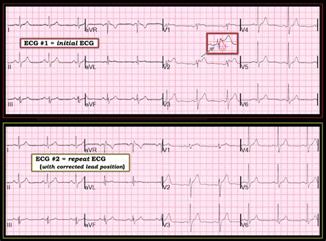 Ecg changes in pe - duncrafts