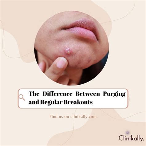 How and Why Niacinamide Causes Skin Purging | Clinikally