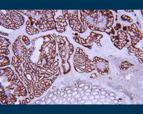 Dana-Farber researchers chart a course for understanding, preventing ...