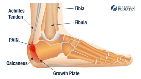 Sever's Disease Treatment