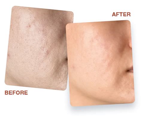 ACE THE GLOW VITAMIN C SKIN BRIGHTENING SET (Glow Cream + Serum)