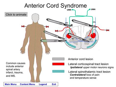 Spinal cord lesions module | PPS