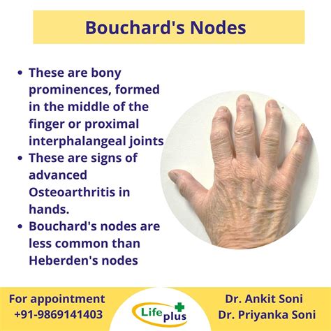 Heberden Nodes Dr. Ankit Soni On X: "Bouchard's Nodes These Are Bony