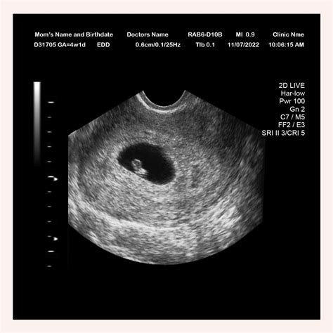 Ultrasound At 5 Weeks