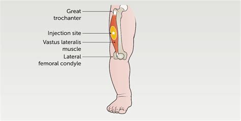 Image result for Injection Sites