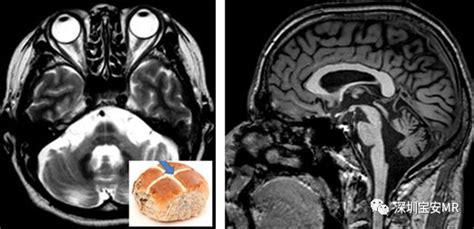 脑组织铁沉积神经变性病临床与影像诊断（一）_Salomao