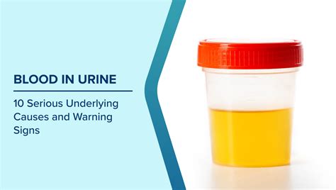 Blood in Urine: 10 Serious Underlying Causes and Warning Signs | Max ...