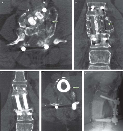 Part II: Spinal-cord neoplasms—primary tumours of the bony spine and ...