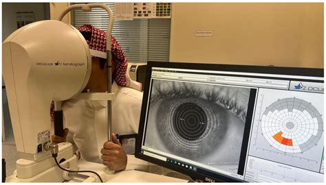Clinical Assessment of Dry Eye Disease in Patients with Keratoconus in ...