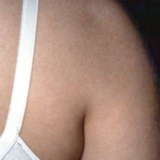 Image result for Sulcus Sign Shoulder Dislocation