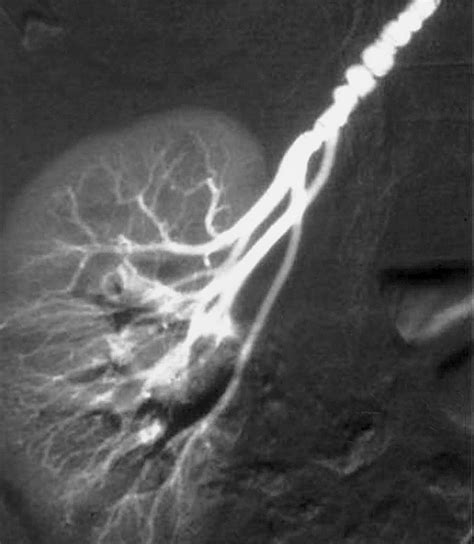 String Of Pearls Radiology at Timothy Samons blog