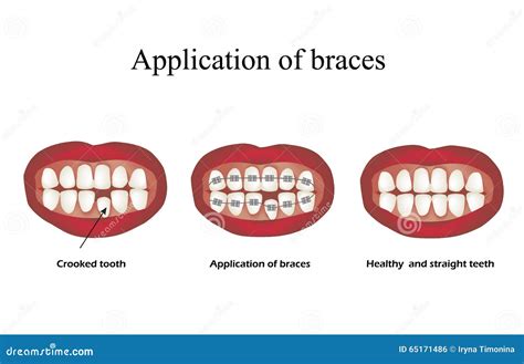 The Use of Braces. Crooked Teeth. Orthodontics. Infographics Stock Vector - Illustration of ...