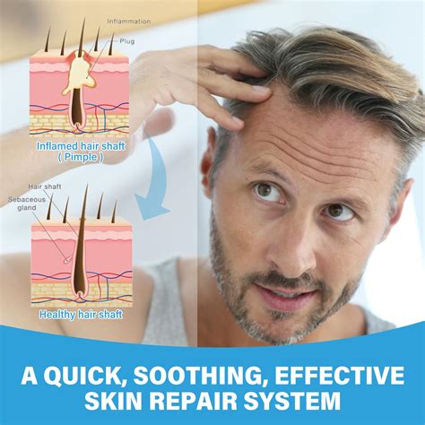 Alsten Folliculitis Treatment Upgrade Folliculitis Cream Fast Acting ...