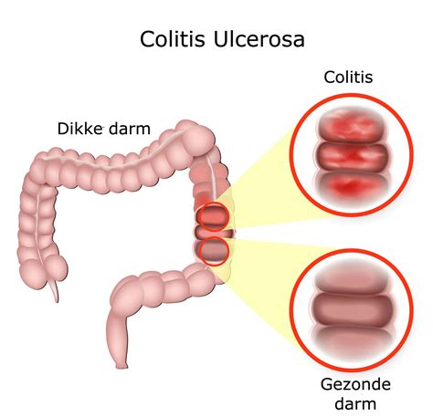 Colitis ulcerosa - Colitis ulcerosa oorzaak - Colitis ulcerosa behandeling