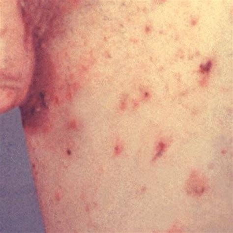 scabies under breast