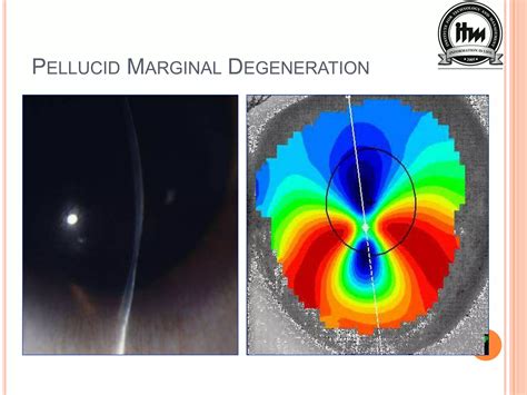 Corneal degeneration ppt | PPTX