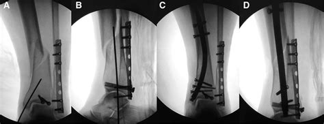 Image result for Ankle Injection Lateral Approach