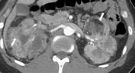 Tuberous Sclerosis Complex (TSC): Renal and Extrarenal Imaging - Academic Radiology