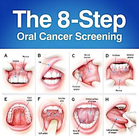oral-cancer - Spruce Ridge Dental Blog Spruce Ridge Dental Blog