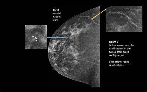 Benign Breast Calcifications | Treatment & Management | Point of Care