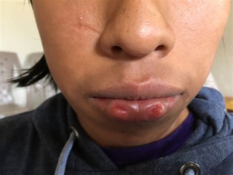 Percent Of Van Woude Syndrome