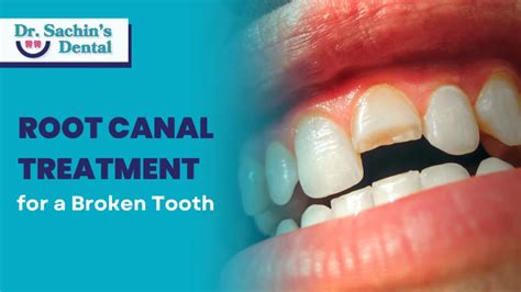 Image result for Root Extraction Tooth Broken Off