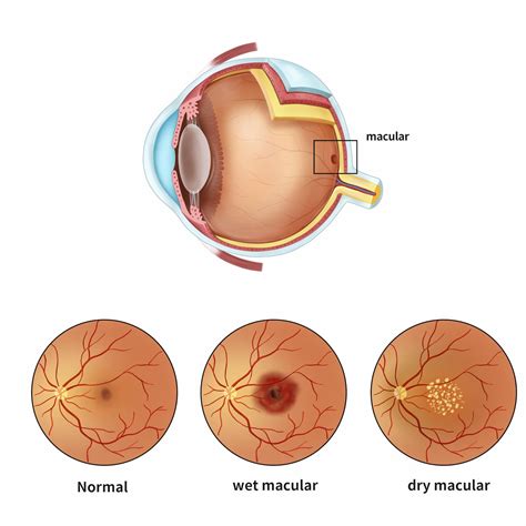 Image result for Macular Degeneration Example