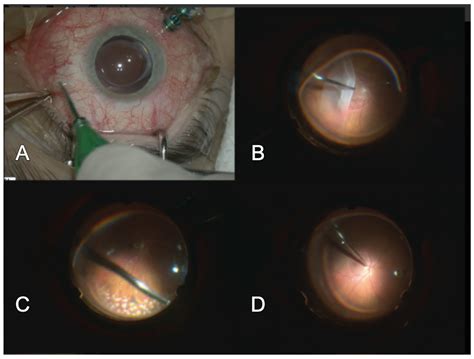 Updates on Treatment Modalities for Primary Rhegmatogenous Retinal ...