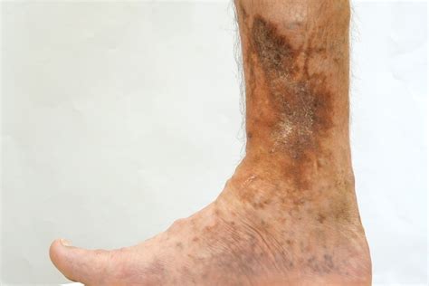 Welcome to Interprofessional Wound Care Association