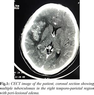 Affective Psychosis: A Rare Presentation of Tubercular Meningitis in a ...