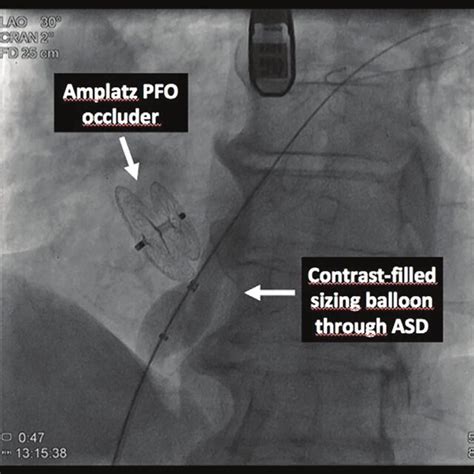 PFO Defect 的图像结果