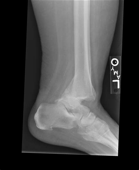 Ankle Fracture and Dislocation - radRounds Radiology Network