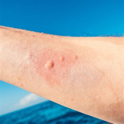 Impressive Info About How To Prevent Jellyfish Stings - Pricelunch34