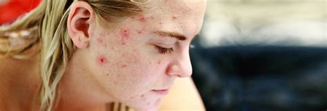 Face Mask Acne: How To Prevent Acne From Face Masks?