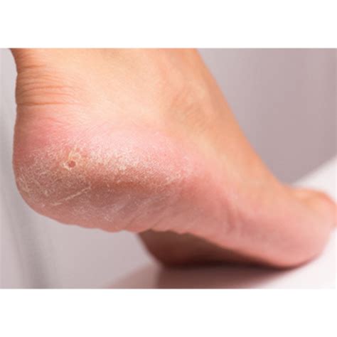 Signs that you need to take care of your feet – LuxaDerme