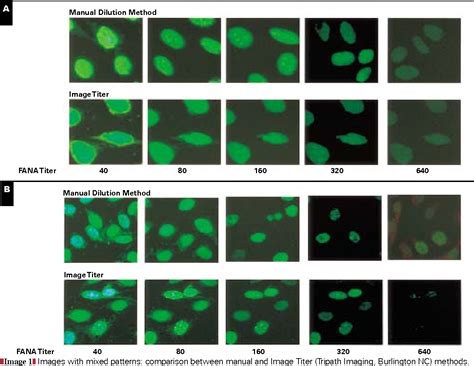 Speckled Antinuclear Antibody