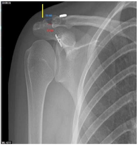 Acromioclavicular Joint X Ray