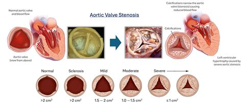 Aortic Stenosis Management Of Asymptomatic Severe Aortic Stenosis:
