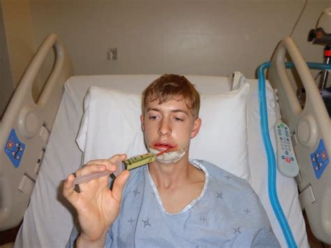 Double Jaw Surgery Wired Shut at Janet Simmons blog