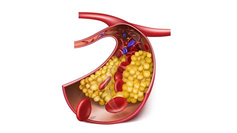 क्या आपको पता है नसों में गंदा कोलेस्ट्रॉल क्यों बढ़ता है? जान लीजिए ...