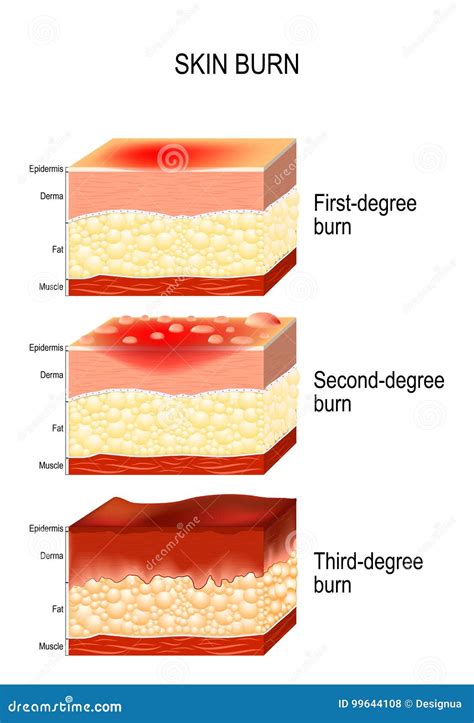 Diagrama De Quemaduras De Tercer Grado Enfoque Dermatológico De Las
