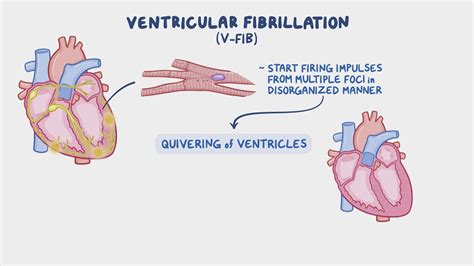 Ventricular Fibrillation Vs Atrial Fibrillation