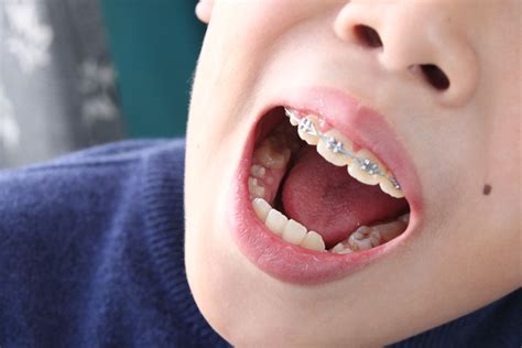 孩子才上幼儿园，却满嘴黑牙了？每天都刷牙还是会蛀牙的！__小豆苗疫苗助手