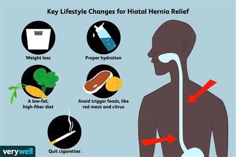 Pain Relief Hiatal Hernia at Aaron Rymer blog