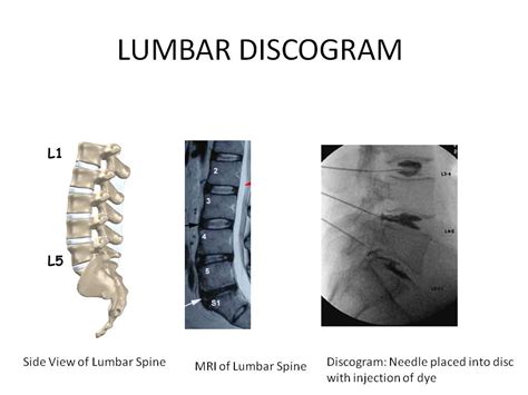 Image result for Lumbar Discogram