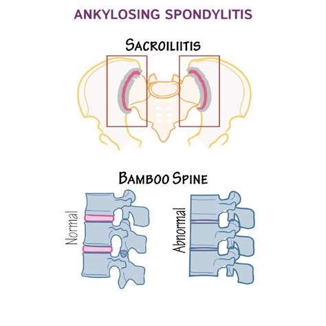 Clinical Pathology Glossary: Ankylosing Spondylitis | ditki medical ...