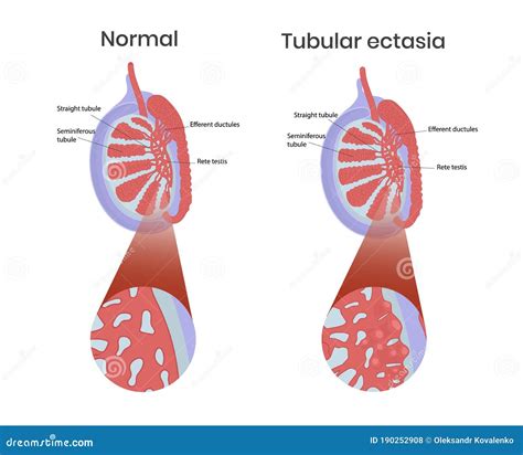 Tubular Ectasia of Rete Testis with Normal Testicular Anatomy Stock ...
