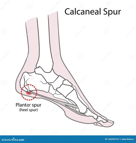 Plantar Spur Calcaneal Spur. Human Foot Bones. Illustration Isolated On A White Background Stock ...