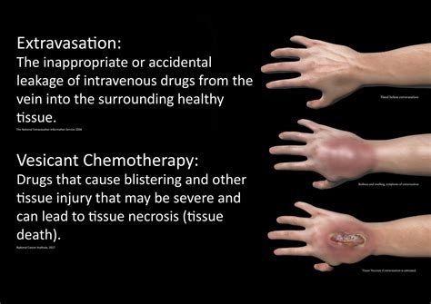 Infiltracao Iv Vs Extravasamento